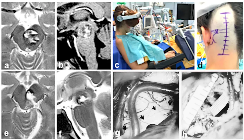 病例二：19岁女性患者