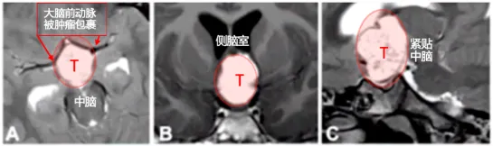 术前：视力受损