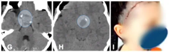 术后：无并发症