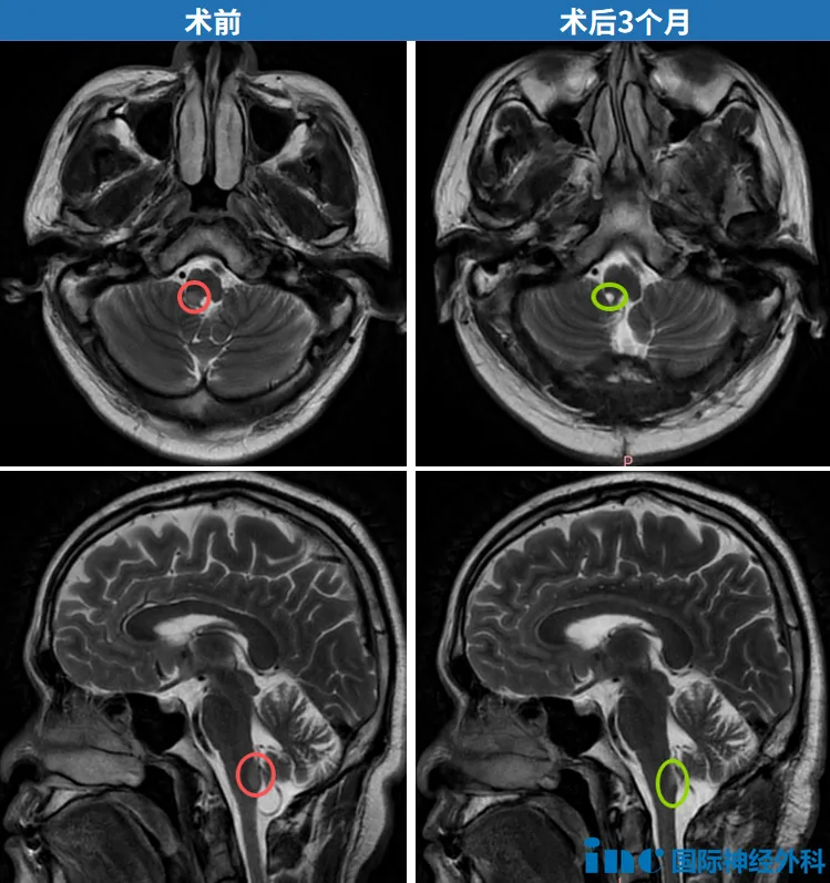 脑干胶质瘤是绝症吗？那个被判无法手术的延髓胶质瘤患者早已回归幸福生活！