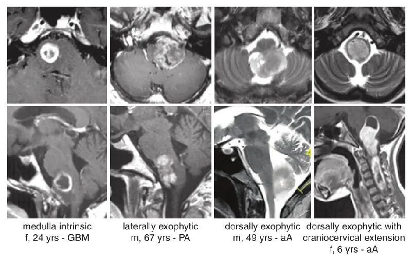 MRI显示延髓区肿瘤的部位与范围代表性图像4