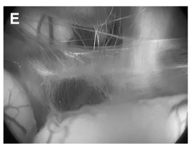 (E)经造瘘口窥见基底动脉。