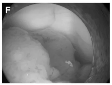 (F)第三脑室后部肿瘤。