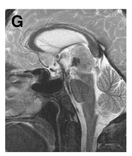 (G)术后第3天MRI，造瘘处可见显著流空信号；ETV后颅内压增高症状完全缓解。