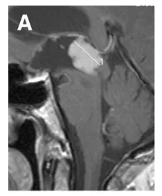 49岁男性，头痛、恶心及呕吐，检查发现第三脑室后部巨大强化病灶(A)。