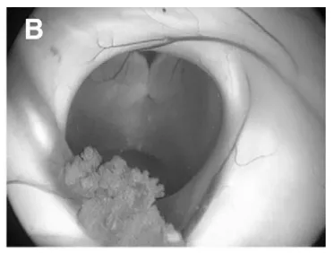 (B)室间孔（Monro孔），选取可同时抵达第三脑室底及肿瘤之入路。