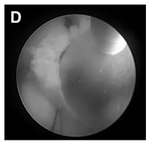 (D)以球囊导管完成第三脑室造瘘。