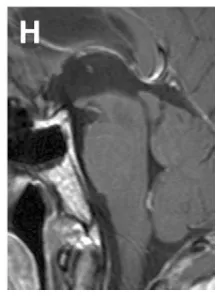 (H)术后2年经幕下小脑上入路全切肿瘤后矢状位T1增强MRI，示肿瘤全切除，患者无神经功能缺损，恢复良好。