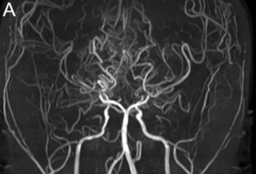 MRA和DSA图像显示双侧末端ICA和PCA狭窄（图A）