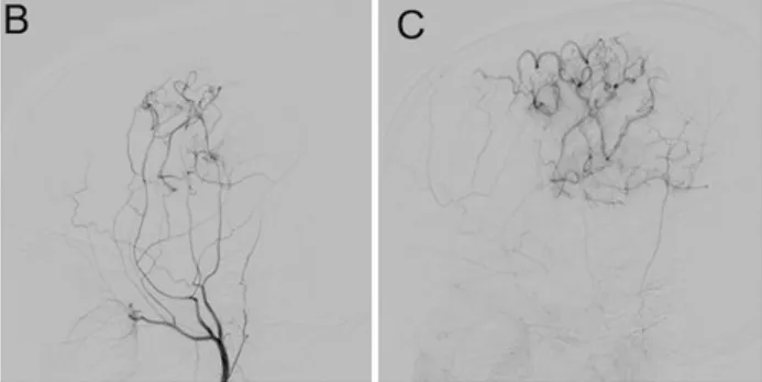 在6个月的随访中，DSA显示旁路通畅，左大脑中动脉区域的血流完全改善。（图B和C）