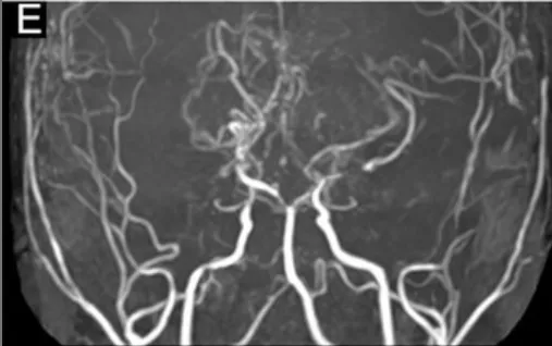 2年后的MRA和DSA显示进行性PCA狭窄（图E）