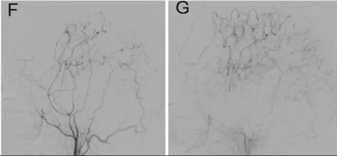 在6个月的随访中，DSA显示先前旁路的通畅性（图F和G）