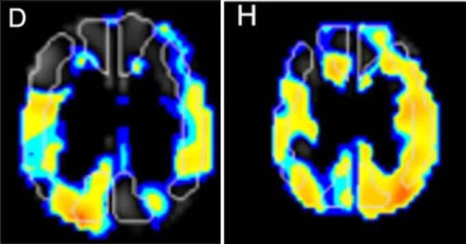 术前：SPECT成像显示左MCA和PCA区域的CVR降低（图D）  术后：SPECT成像显示MCA和PCA区域的CVR显著改善（图H）