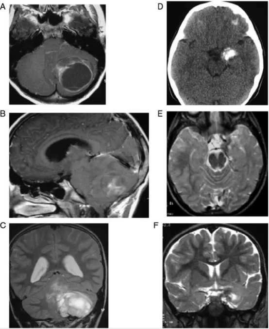 【INC国际大咖研究成果】儿童脑肿瘤治疗前的神经心理学缺陷