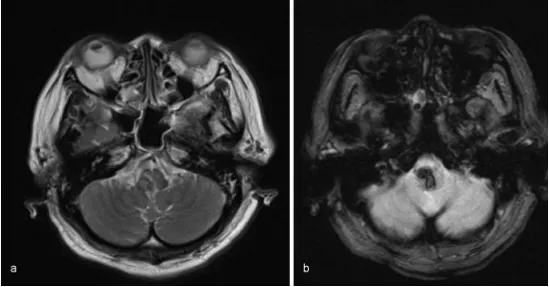 高血压竟致脑干出血！70岁的她呼吸衰竭命悬一线，如何靠一场手术逆转危局？