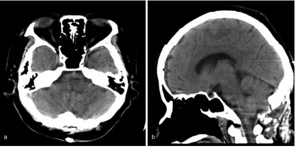 图：术后电脑断层扫描显示延髓血肿消失