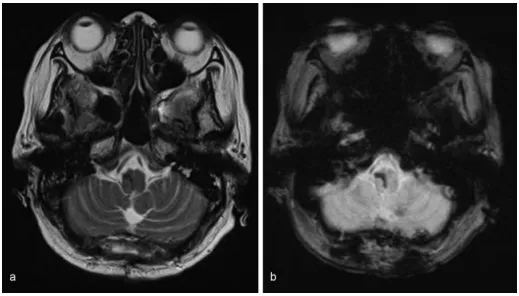 图：术后5周磁共振成像未见结构异常。