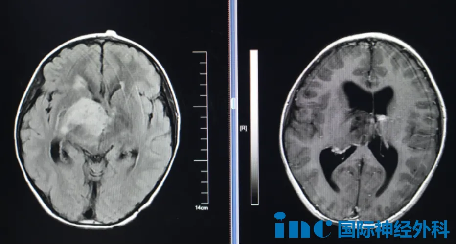 8岁男孩弥漫性胶质瘤？  　　下一步该怎么办？
