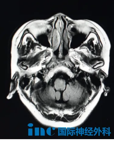 桥脑腹侧、中脑脚间窝占位性病变