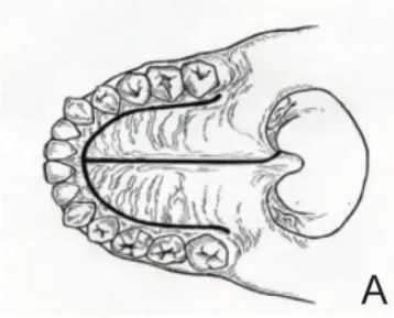 于腭部作U形黏膜切口：展示黏膜切口设计。切口中线位于腭中缝处，术中注意避开悬雍垂。