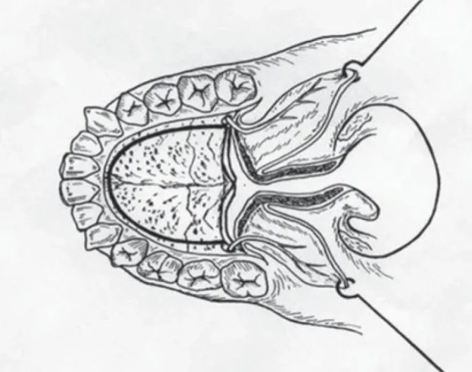 自腭骨剥离黏膜骨膜瓣，并沿中线切开软腭，形成腭瓣。术中需特别注意将腭大动脉保留在腭瓣的蒂部。图中实线标示截骨线。