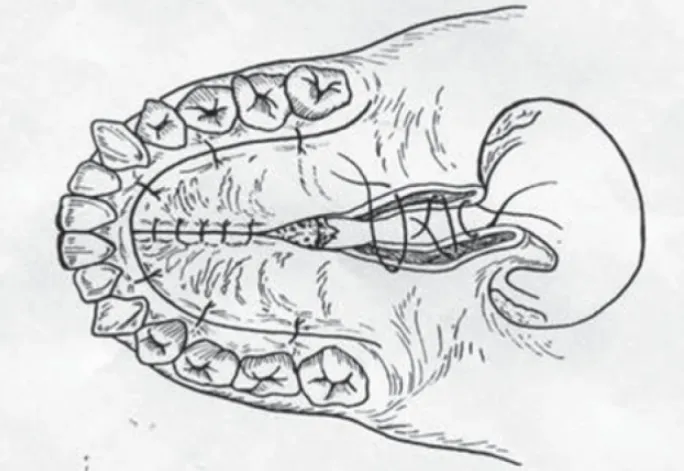 腭部重建示意图：将硬腭骨板复位，并通过双层缝合固定腭瓣。