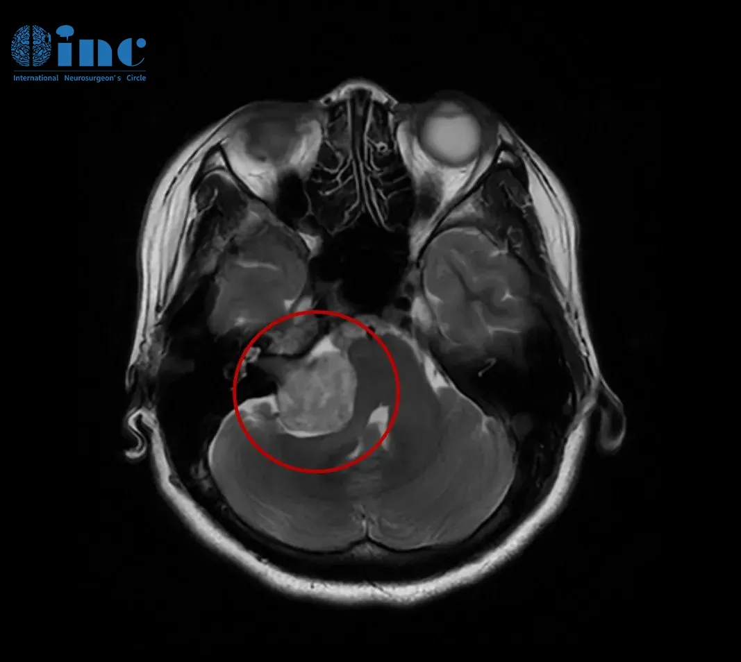 听力下降、面部麻木…… 警惕听神经瘤作祟！