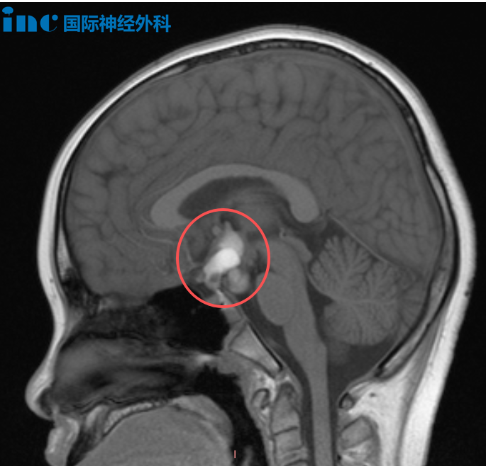 12岁男孩涛涛今年8月因头痛查出颅咽管瘤，20mm×15mm×27mm大小的病变已经让脑干受压后移，压迫到视交叉后方的视路系统。