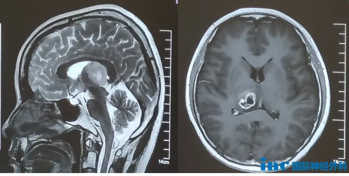右侧丘脑病变，大小约25mm×23mm×24mm，虽然无明显临床症状