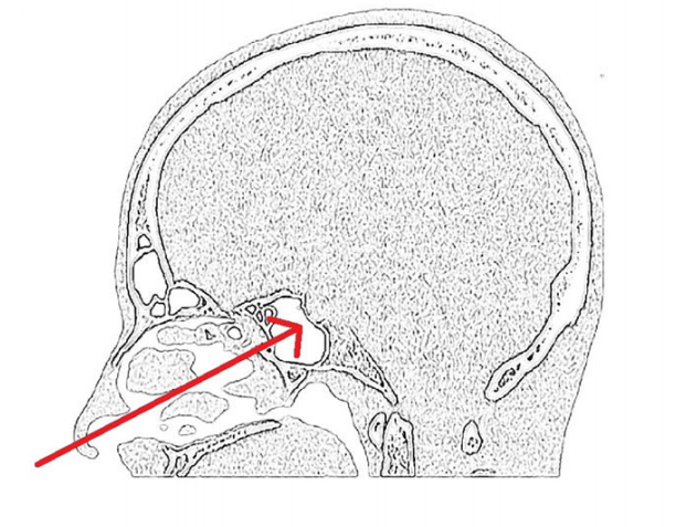 手术入路示意图