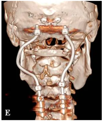 术后三维CT显示