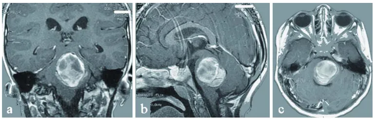 脑海绵状血管瘤是先天性的吗？3岁女孩突发脑干出血，母女俩双双确诊