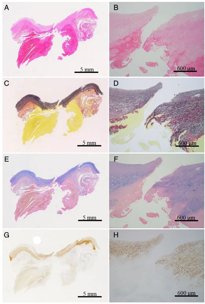 破裂动脉瘤病变连续纵切面的病理学视图显示了涉及内膜、中膜和外膜的破裂点。