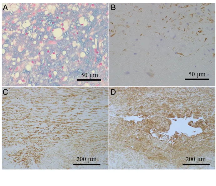 假性动脉瘤破裂点切片。（A）中膜细胞外基质中可见黏液样物质聚集。（B）观察到平滑肌细胞密度显著降低。（C）中膜平滑肌细胞排列紊乱。（D）可见散在的不规则形状空腔。