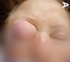 脑膜瘤压迫致嗜睡、偏瘫！女子眼球突出17年后病情危急，开颅手术化险为夷