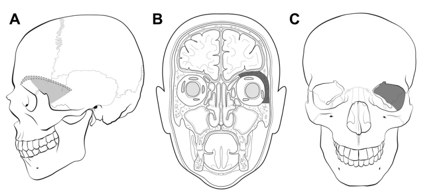 阴影区域标示了从外侧观(a)、冠状位内侧观(b)和冠状位外侧观(c)所见需切除的骨质范围。阴影部分包括眶外侧壁、眶上壁、视神经管及前床突。保留了眶缘。