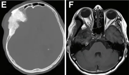 术后照片显示右眼眼球突出良好复位(图G)