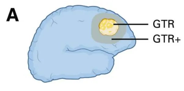 （A）大体全切除及超全切除示意图：展示GTR（大体全切除）、GTR+（超越影像学肿瘤边界的切除）与GTR–（切除范围≤100%）的界定标准。