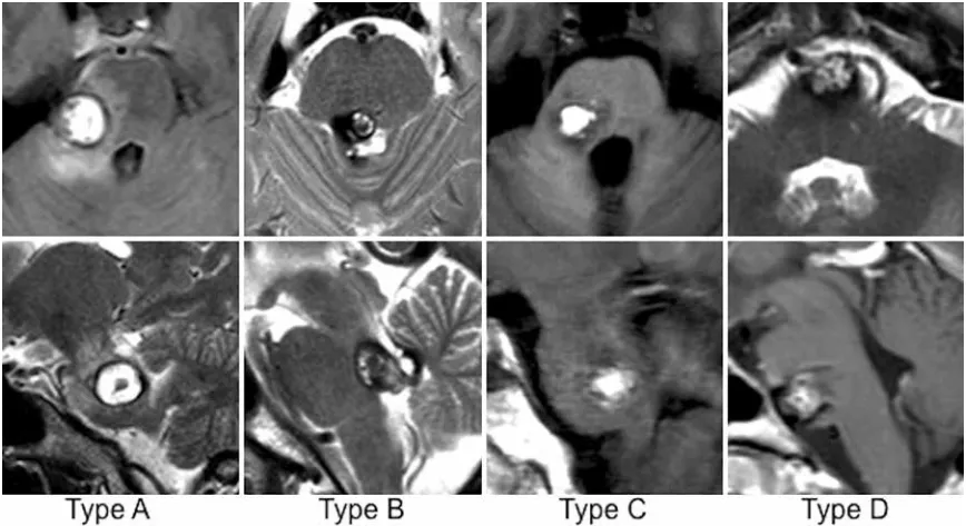 四种类型的脑桥“炸弹”