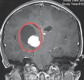 “我好期待开学！”胶质瘤女孩开颅后，医生说她有望治愈！