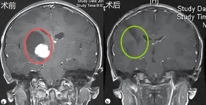 红色为术前，绿色为术后，显示肿瘤全切，脑组织复位，无脑出血、脑水肿等损伤。