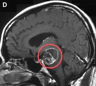“手术可以等2个月吗？”压迫脑干的脑瘤1个月内出血，致他偏瘫加重紧急入院