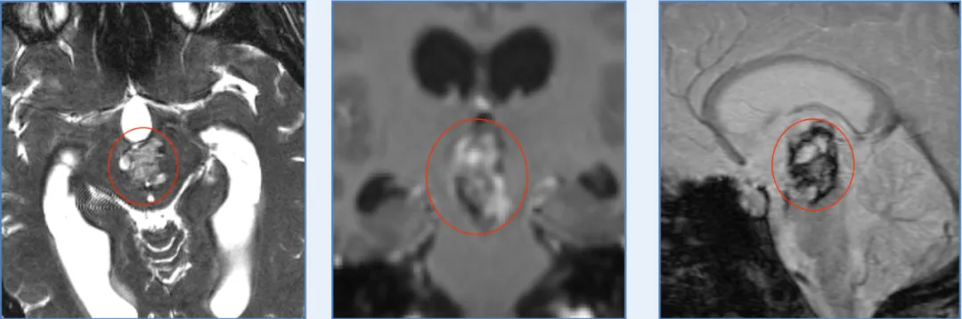 21 岁的我差点栽在脑血管瘤上：从 “等死” 到拿学位，这步棋救了我！