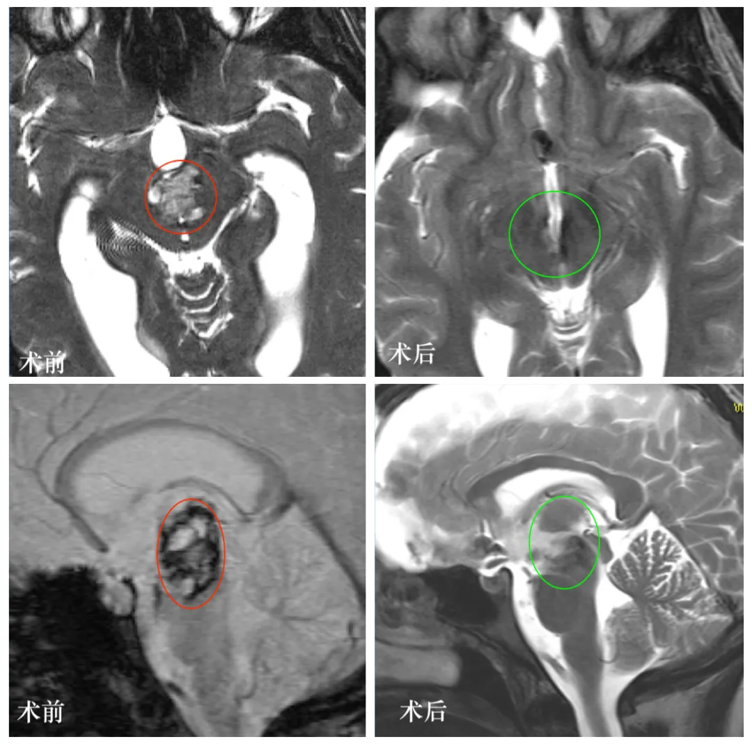 图：手术前后颅脑MR对比，术后MR中脑脑干病变全切，无脑组织损伤等。