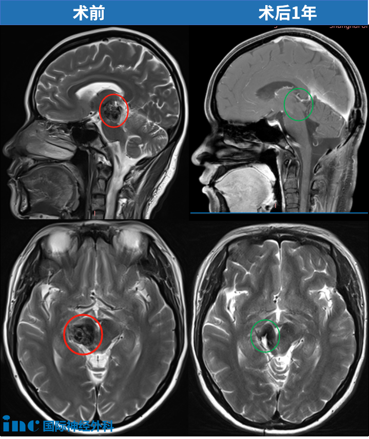 37岁女性丘脑海绵状血管瘤