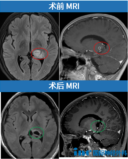 10岁男孩丘脑胶质瘤