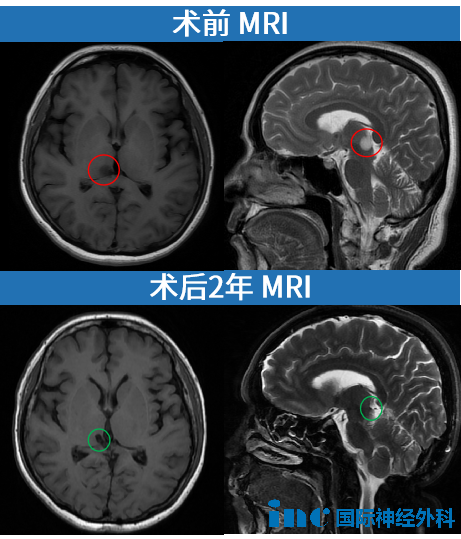 52岁女性丘脑胶质瘤