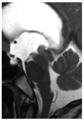一颗在脑内“游走”的恶性肿瘤，像瓶塞堵住生命要道，昏迷的12岁男孩如何苏醒?