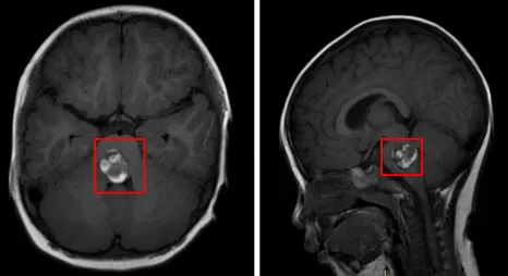 当质子治疗对室管膜瘤失效时，一个手术全切的机会出现了……