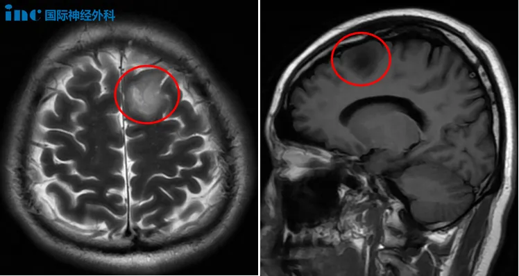 体检查出胶质瘤